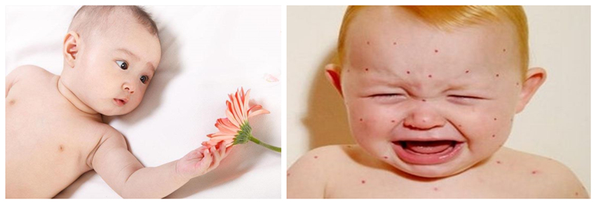 兒童濕疹反反復復，您有在家安裝家用除濕產品嗎？